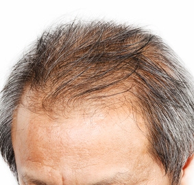 hair loss treatments Southampton
