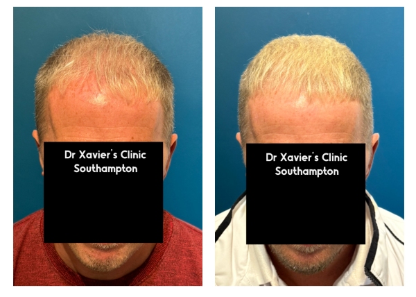 Exosomes purasomes cellular regeneration for healthier hair Southampton