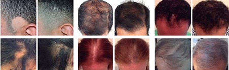 Mesotherapy with XL Hair Treatment for Hair Regrowth Southampton