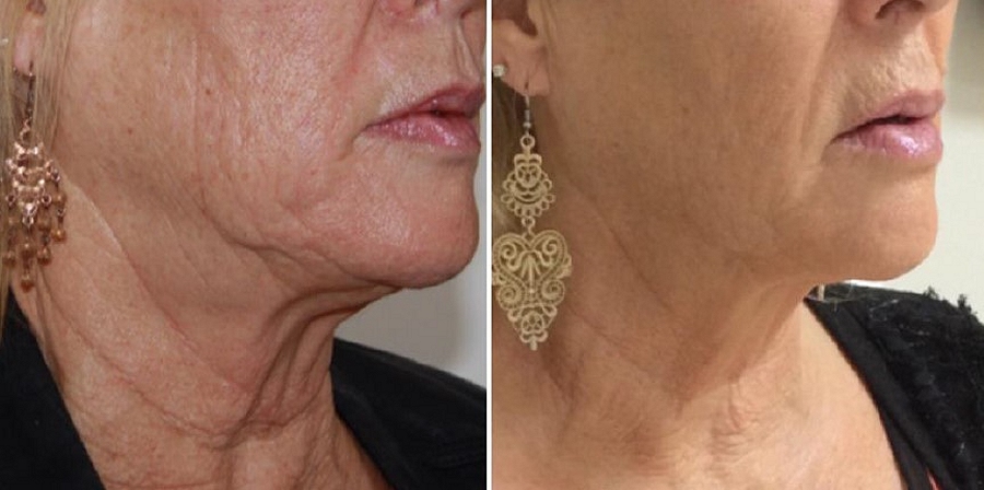 Non-Surgical Face and Neck Lifting With HIFU southampton