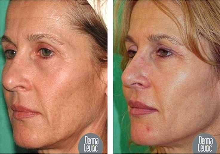 chemical skin peels southampton