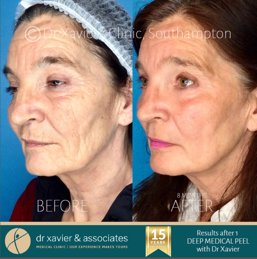 botox southampton hampshire