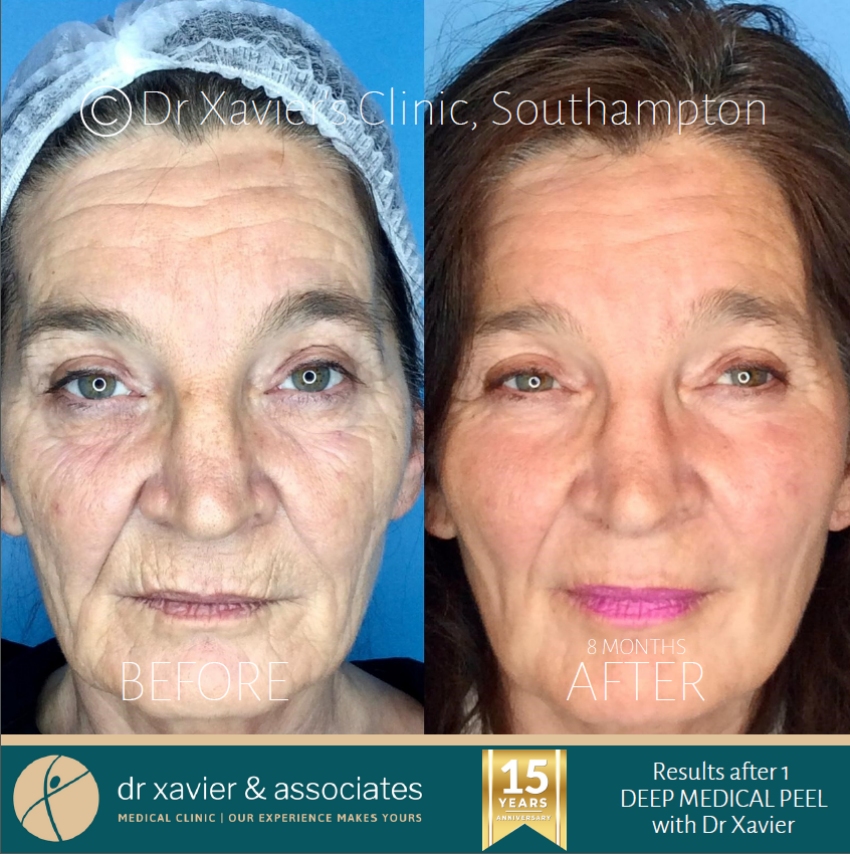 Phenol Peels (Deep Peels) for deep wrinkles Southampton Hampshire