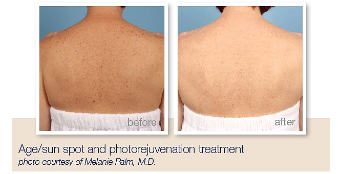 Treatment for pigmentation, age spots, sun damage, broken capillaries Southampton
