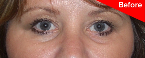 under eye treatments southampton